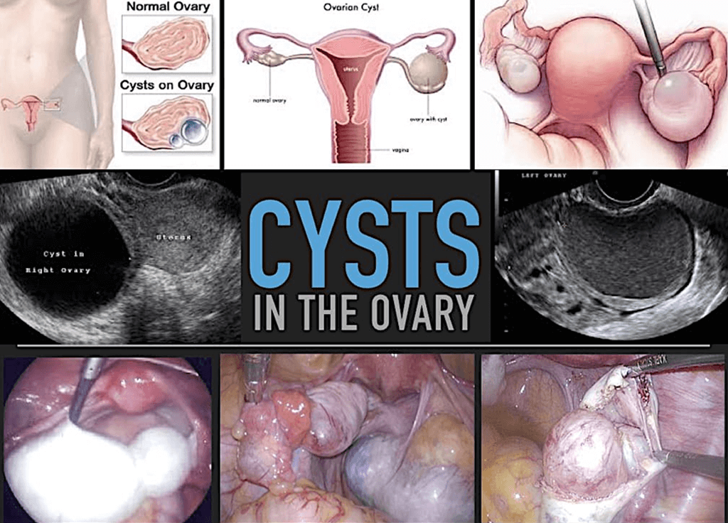 Get to know ovarian cyst, - Bangkok Hospital Thailand